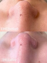 マヴィ(Mavie)/韓国式３D毛穴洗浄　