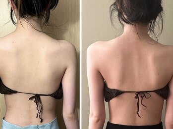 マイティー整骨院 ココア(CoCoa)/肩甲骨洗浄