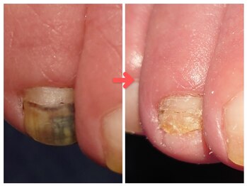 アンティ(Aunty)/足爪のケア