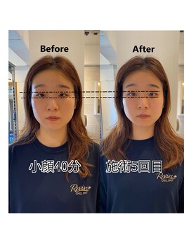 リバイブ 五反田店(REVIVE)/目元左右差改善小顔矯正5回施術