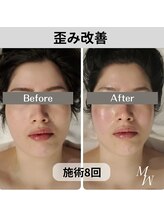 ミピマム/歪み改善　左右対称