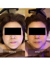 リセット 宇都宮店(R'eset)/小顔矯正コース　1回目