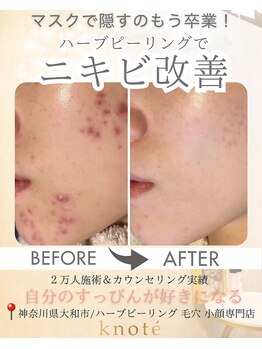 ノット(knote)/衝撃ビフォアフ1