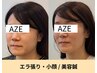 人気！【エラ張り・食いしばり】に特化した美容鍼！初回体験¥1500 