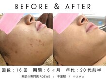 ロエヴェ(ROEWE)/ニキビ改善・毛穴ケア・肌質改善