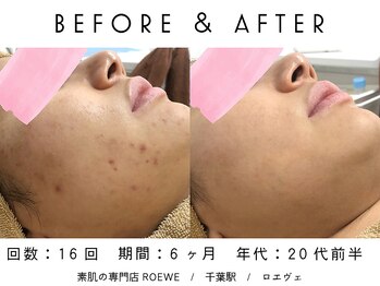 ロエヴェ(ROEWE)/ニキビ改善・毛穴ケア・肌質改善