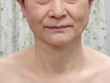 目元 口元のたるみ 眉間シワ改善専門サロン