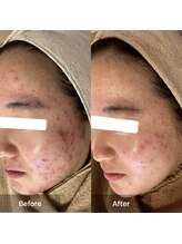 モカ 天王寺店(MOKA)/剥離ハーブピーリングニキビケア