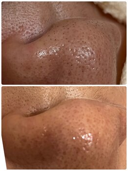 エステスタジオ アキコ(AKIKO)/毛穴ケア