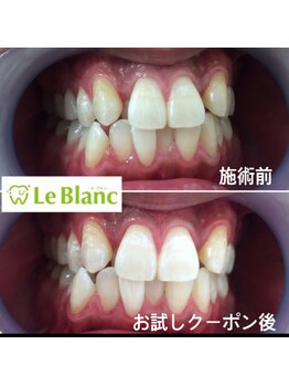 ルブラン 奈良店(Le Blanc)/歯がキレイだと