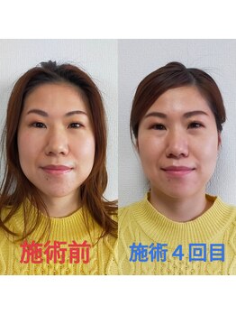 シャルム(Charme)/小顔矯正施術４回後