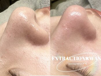 ワクシングトウキョウアイス 北千住西口店(waxing tokyo ice)/毛穴エクストラクション