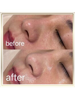 ピュアスキンサロン 恵比寿店(pure skin salon)/自社開発W水光ピーリング