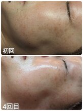 ウララ(ulala)/ララピール4回目