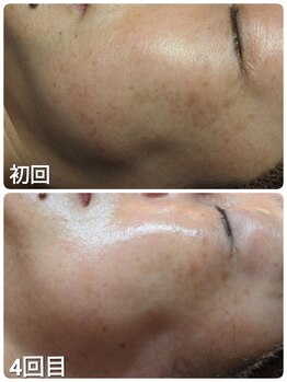 ウララ(ulala)/ララピール4回目