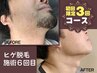【初回限定/メンズ脱毛】ヒゲまるごとメンズヒゲ脱毛◆3回コース￥7,980