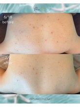 ポノ(Pono)/2回目の施術☆