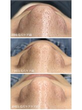 ジュエカフネ 広尾(JueCAFUNe)/鼻の集中毛穴ケア＋プラズマ経過