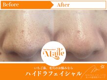 まいれ鍼灸院整骨院 整体院 草津院/ハイドラフェイシャル/いちご鼻