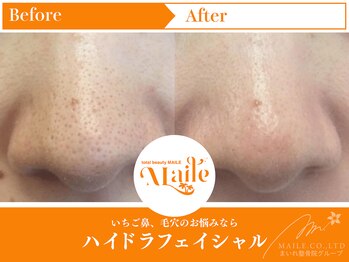 まいれ鍼灸院整骨院 整体院 草津院/ハイドラフェイシャル/いちご鼻