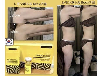 美ネージュの写真/ 【1ヶ月で激変】レモンボトル×4D小顔矯正×引き締めマシンの最強SET！イベント・挙式前の駆け込み大歓迎