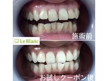 ルブラン 奈良店(Le Blanc)/歯！歯！歯！スマイル33000円！