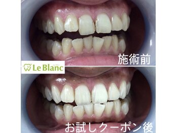 ルブラン 奈良店(Le Blanc)/歯!歯!歯!スマイル33000円!