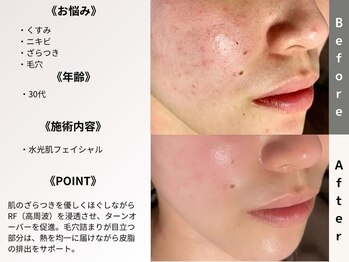 ルディラ 横浜店/水光肌フェイシャル