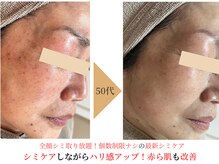 エソア(esoa)の雰囲気（全顔シミケアエリア、個数制限なし！シミ、たるみケアも同時に♪）