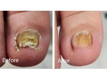 レフス 北参道店(REFUSS)/肥厚爪