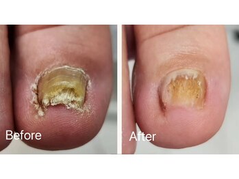 レフス 北参道店(REFUSS)/肥厚爪