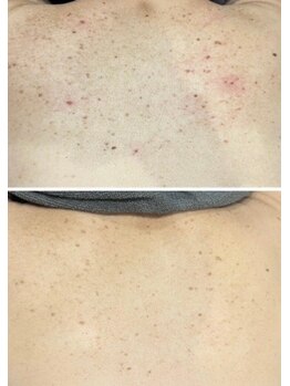 シエル(Ciel)/シミケア光フェイシャル