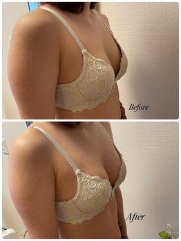 ラディス(Radice.)/【バストアップ症例】☆