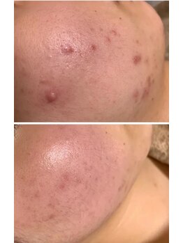 マリエンドリー/ニキビ改善◎