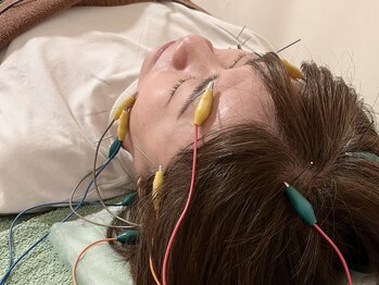 久心宝鍼灸院/通電美容鍼