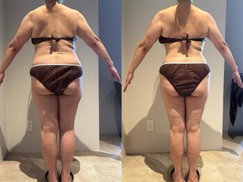 アンティアージュ 福岡本店(antiage)/寝てるだけで全身痩せが叶う♪