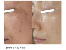 ストーリー 小田原(STORY)/褒められ美肌★ダクトピール