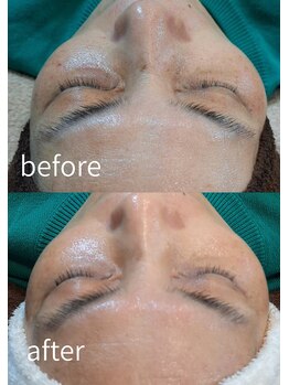 アースコアフュールボーテ ひたち野うしく店(EARTH coiffure beaute)/くすみ改善も光フェイシャルで♪