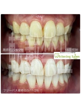 ホワイトニングサロン 広島店/【ホワイトニング18回照射】