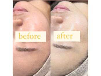 クレセント(crescent)/”透明感を出す”には光彩美白