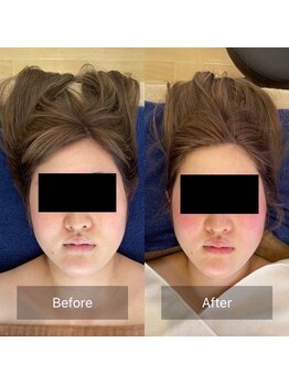 リセット 宇都宮店(R'eset)/小顔矯正コース 1回目