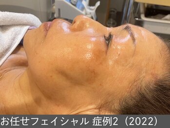 オアシスラグーン(OASIS LAGOON)/お任せフェイシャル(症例2)