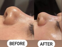 ソーレエルーナ(SOLE e LUNA)/小鼻黒ずみ毛穴洗浄ハイドラ