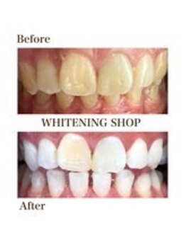 ホワイトニングショップ 新宿店/【ホワイトニング】BeforeAfter