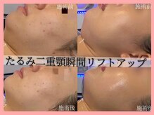 ハイフン(HIFUN)