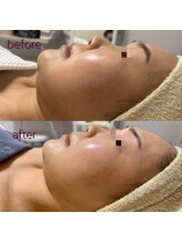 リボーン(be reborn)/フェイスラインもスッキリします