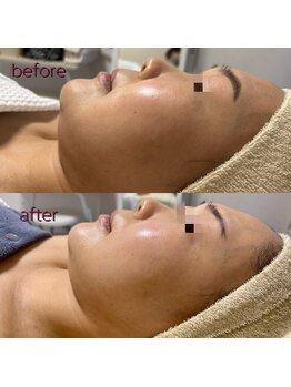 リボーン(be reborn)/フェイスラインもスッキリします