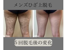 グロワール(gloire)/メンズひざ上脱毛BeforeAfter