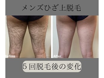 グロワール(gloire)/メンズひざ上脱毛BeforeAfter