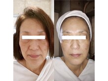 コタカ(KOTAKA)/＜筋膜リリース＞